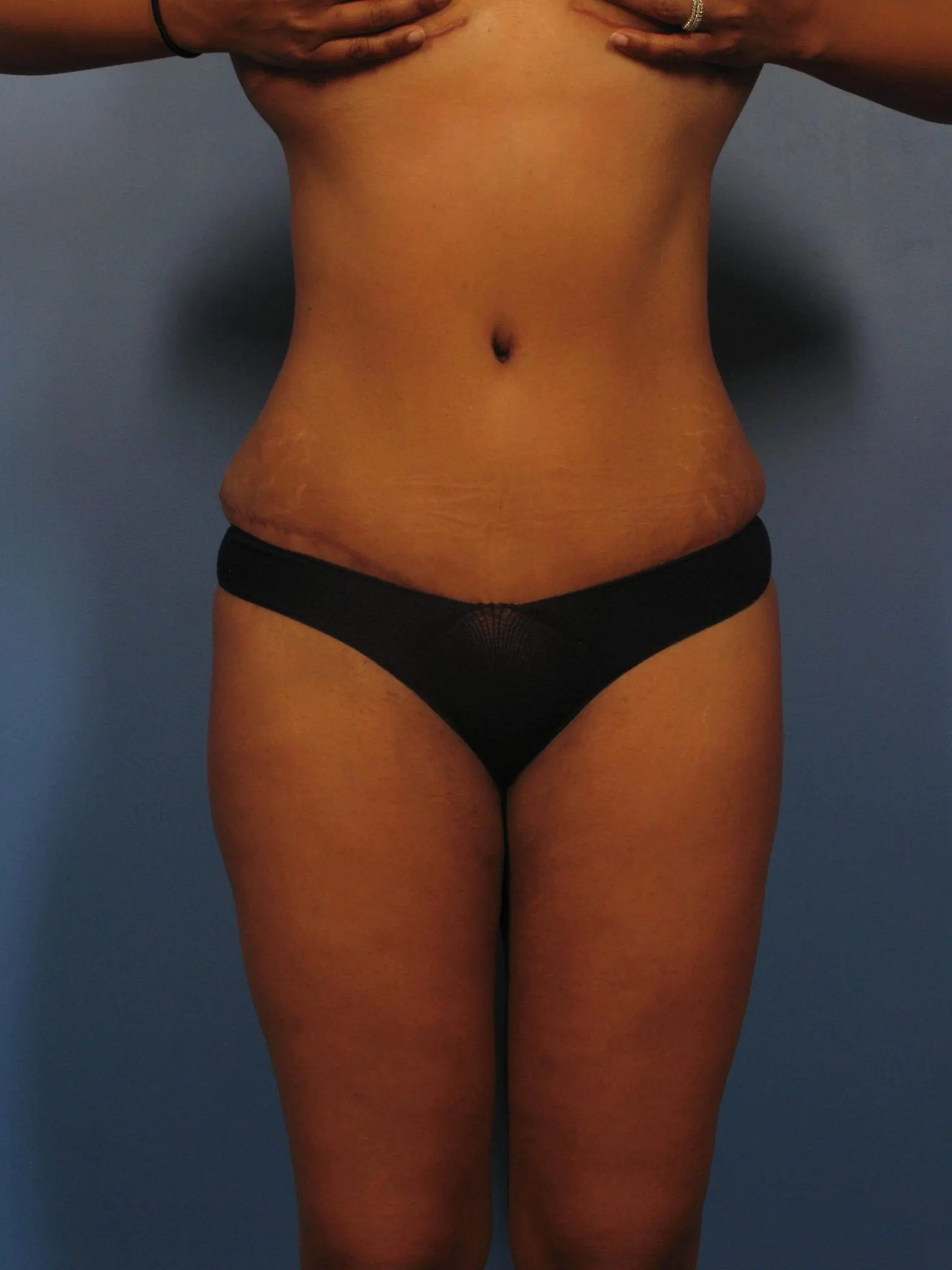 Liposuction - Case 364 - After