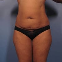 Liposuction - Case 364 - Before