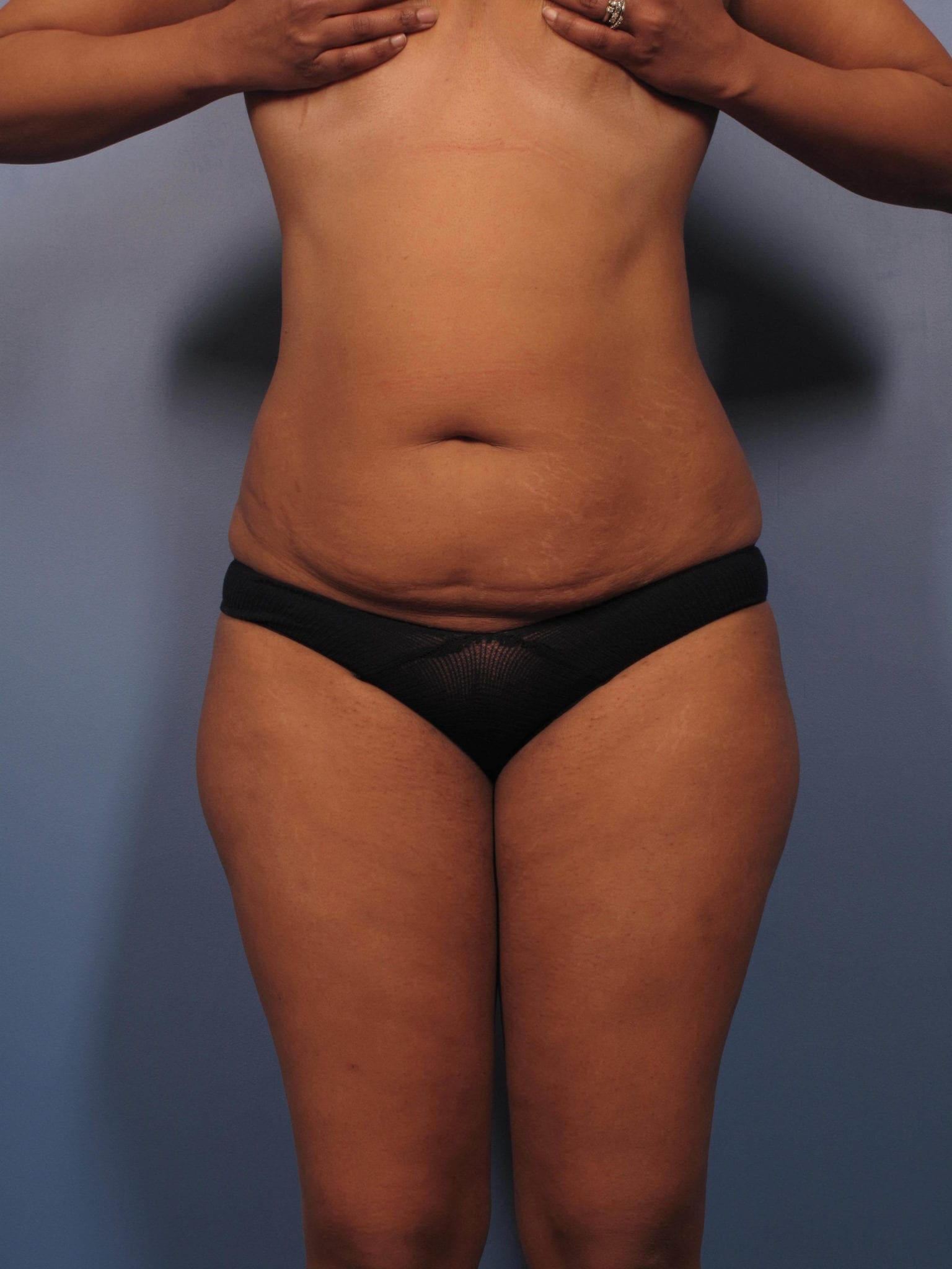 Tummy Tuck Patient Photo - Case 364 - before view-