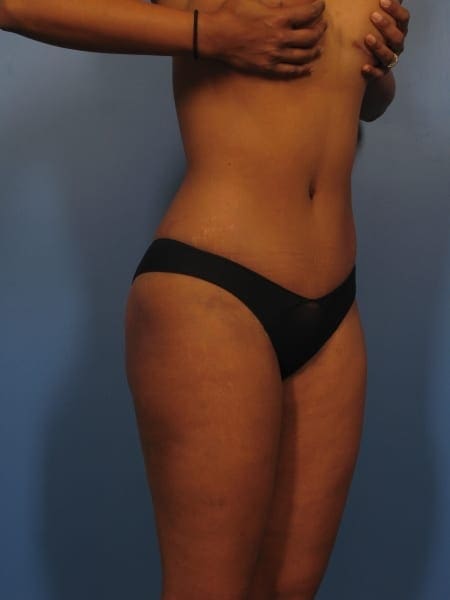 Tummy Tuck Patient Photo - Case 364 - after view-1