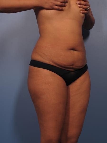 Liposuction Patient Photo - Case 364 - before view-1