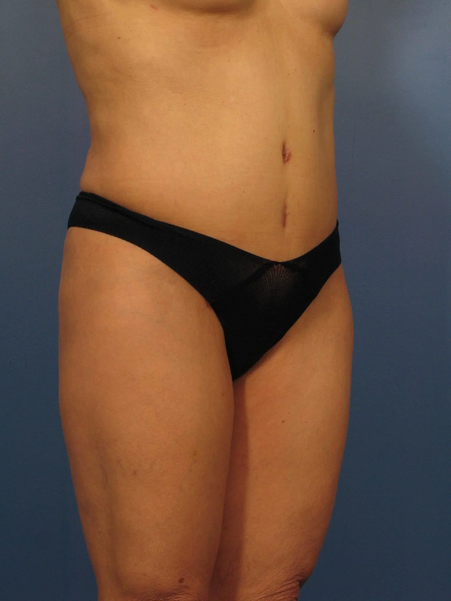 Liposuction Patient Photo - Case 366 - after view