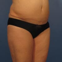 Liposuction - Case 366 - Before