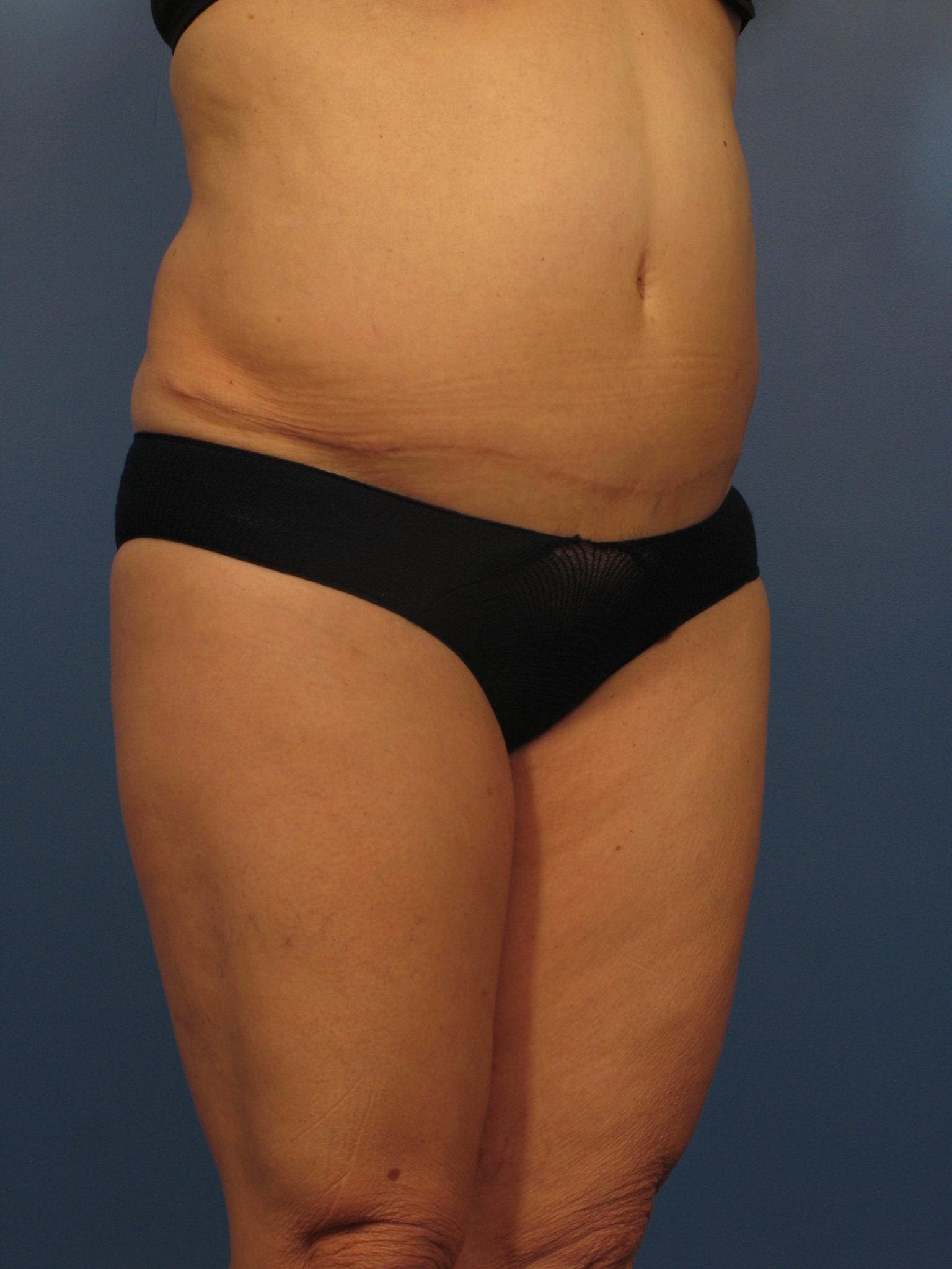 Tummy Tuck Revision - Case 366 - Before