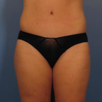 Tummy Tuck - Case 367 - After