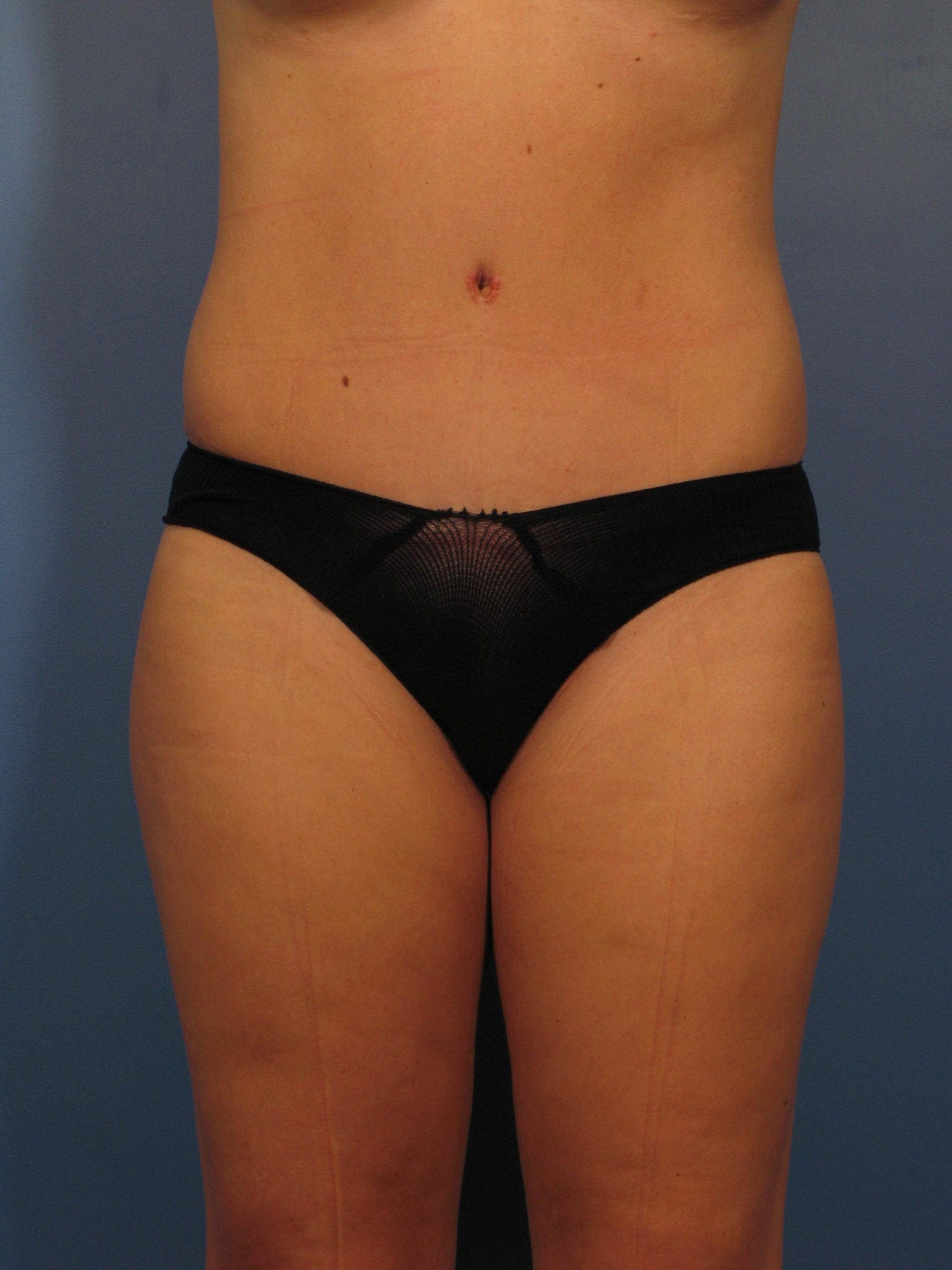 Tummy Tuck Patient Photo - Case 367 - after view