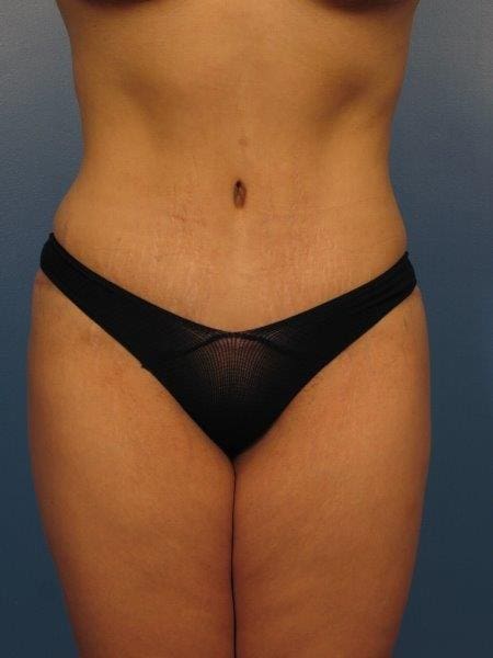 Breast Augmentation with Lift Patient Photo - Case 334 - after view-4