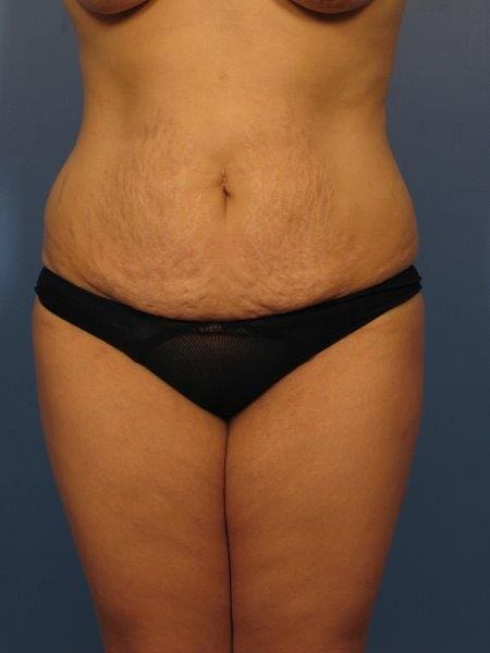 Breast Augmentation with Lift Patient Photo - Case 334 - before view-4