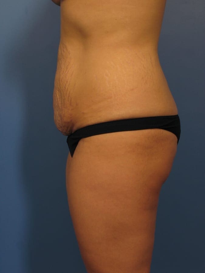 Breast Augmentation with Lift Patient Photo - Case 334 - before view-3