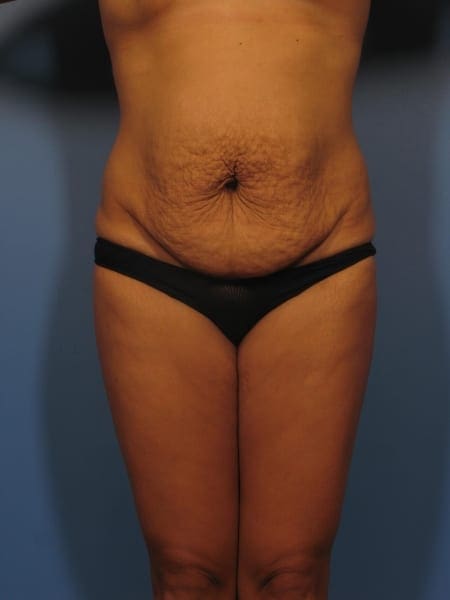 Breast Lift Patient Photo - Case 338 - before view-4