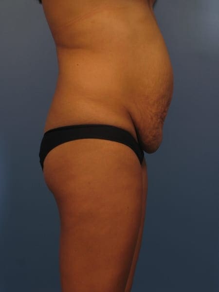 Breast Lift Patient Photo - Case 338 - before view-3