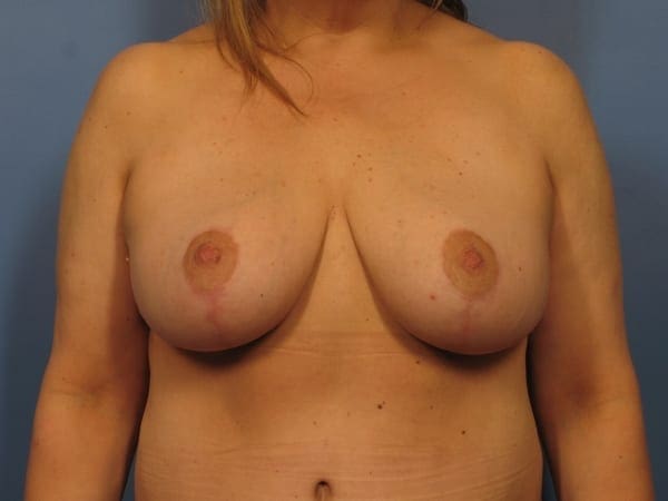 Breast Augmentation with Lift Patient Photo - Case 372 - after view