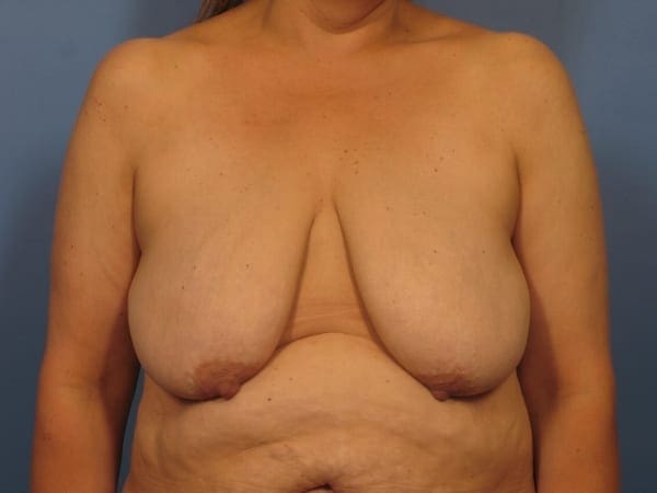 After Major Weight Loss Patient Photo - Case 392 - before view-1