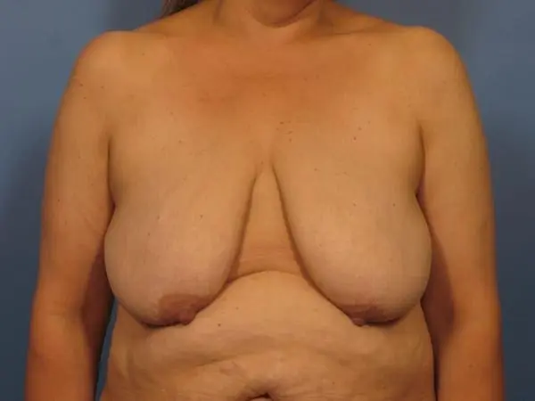 After Major Weight Loss Patient Photo - Case 392 - before view-1