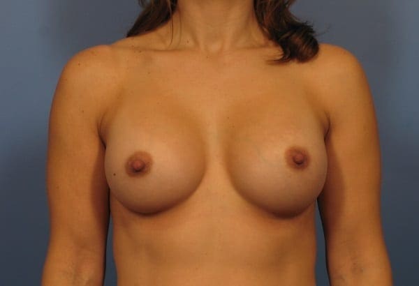 Breast Augmentation Patient Photo - Case 333 - after view