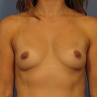Breast Augmentation - Case 333 - Before