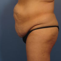 After Major Weight Loss - Case 392 - Before