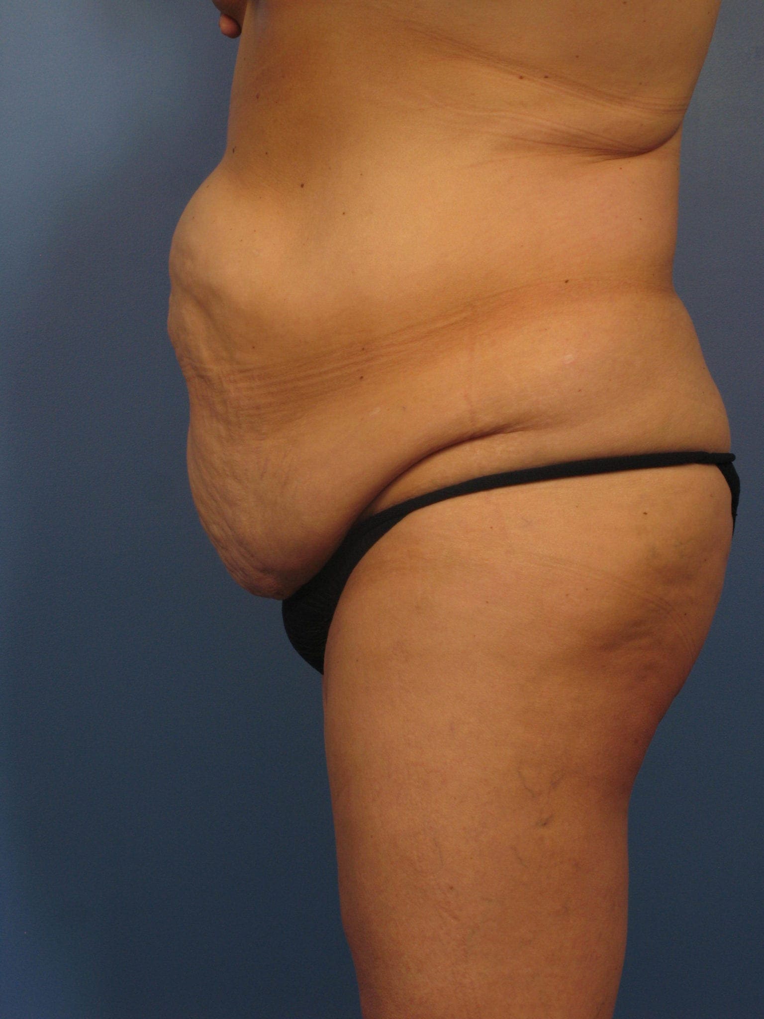 Breast Augmentation with Lift Patient Photo - Case 372 - before view-3