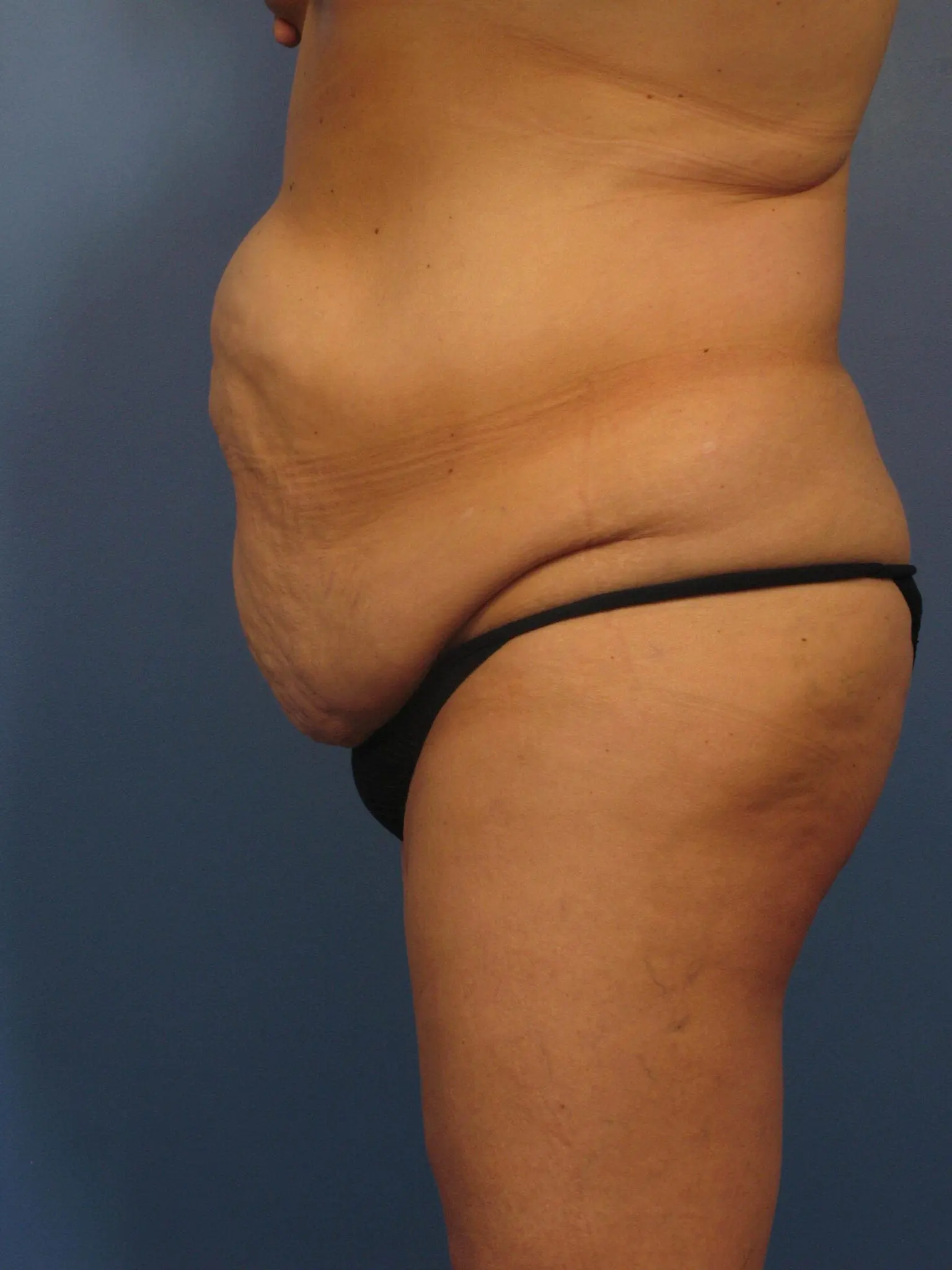 After Major Weight Loss Patient Photo - Case 392 - before view-