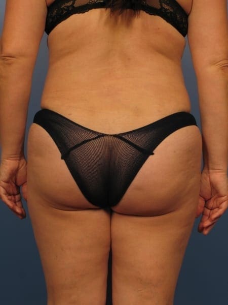 Liposuction Patient Photo - Case 359 - after view-1