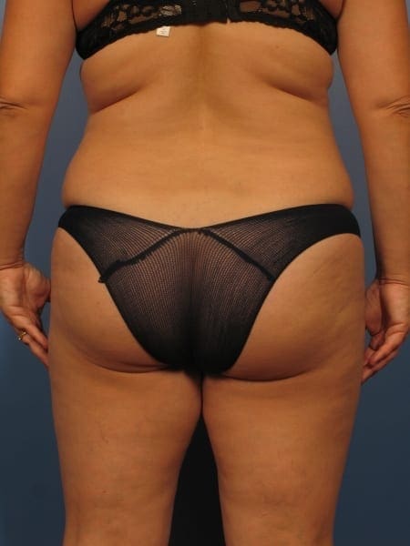 Liposuction Patient Photo - Case 359 - before view-1