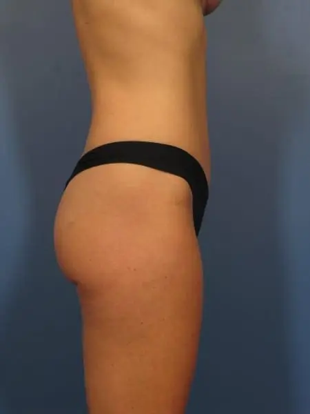Breast Augmentation with Lift Patient Photo - Case 327 - after view-1