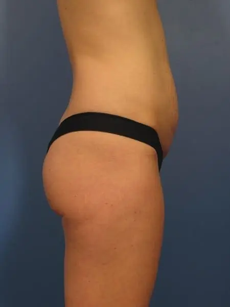 Breast Augmentation with Lift Patient Photo - Case 327 - before view-1