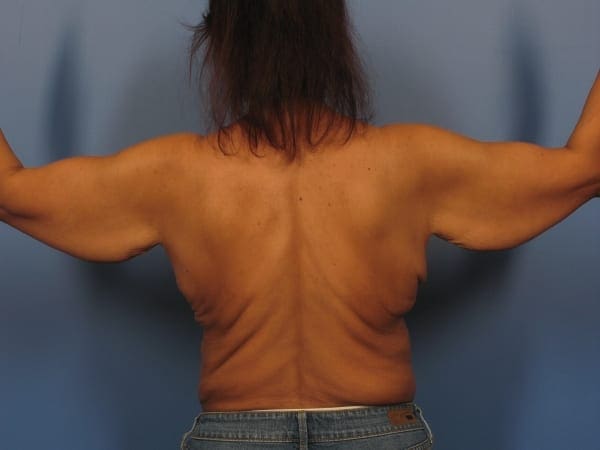 After Major Weight Loss Patient Photo - Case 325 - before view-