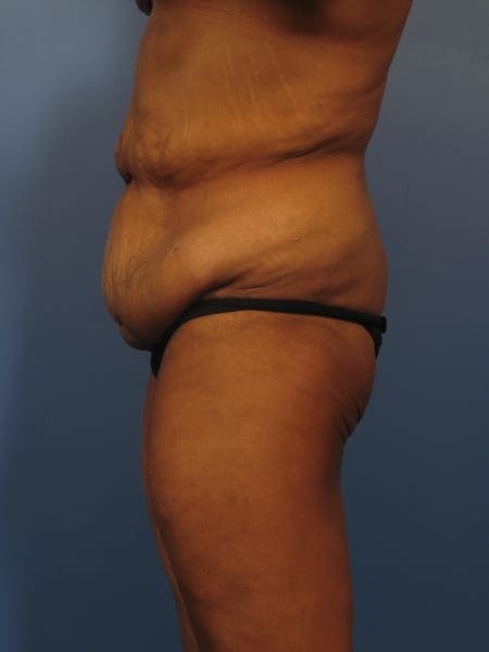 After Major Weight Loss Patient Photo - Case 325 - before view-2