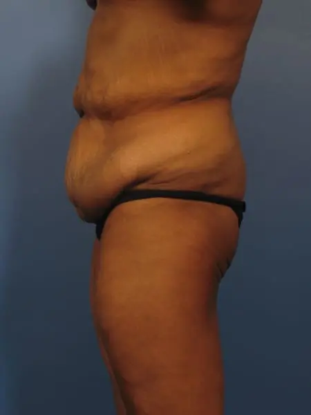 After Major Weight Loss Patient Photo - Case 325 - before view-3