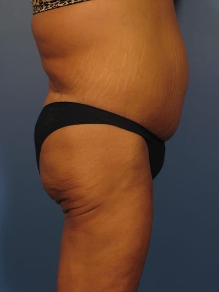 Tummy Tuck Revision Patient Photo - Case 354 - before view-1