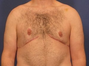 Before and After (for Men) Patient Photo - Case 380 - after view-1