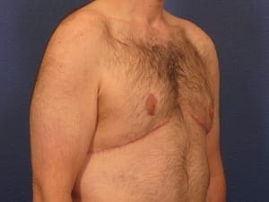 Before and After (for Men) Patient Photo - Case 380 - after view-0