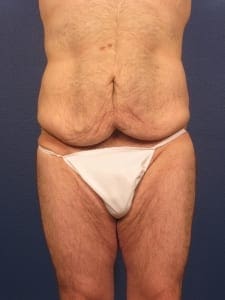 Before and After (for Men) Patient Photo - Case 381 - before view-