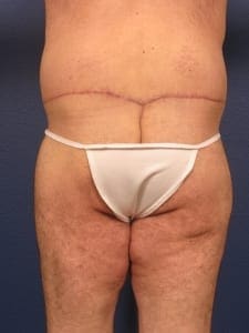 Before and After (for Men) Patient Photo - Case 381 - after view-2